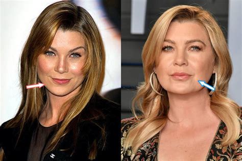 ellen pompeo lip fillers